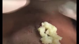 Crazy Satisfying cyst and Blackheads Remove 2024 [upl. by Ahsitan]