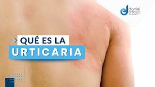 Psoriasis en Cuero Cabelludo 💇 Aplicación de Tratamientos Tópicos [upl. by Akeemaj]