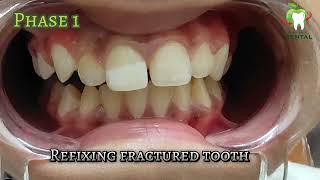 Refixing fractured tooth with colour correction I ഒടിഞ്ഞ പല്ലു ഒട്ടിച്ചു ശെരി ആക്കൽ [upl. by Notnelc583]