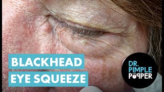 Blackhead Eye Squeeze [upl. by Gatian]