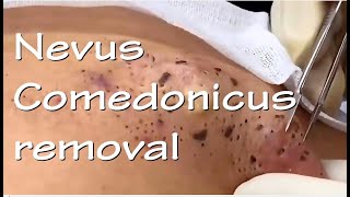 Nevus Comedonicus removal  Video 3 of 3 The ultimate quotblackheadquot removal video [upl. by Budwig226]