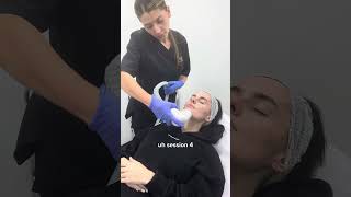 Amber Davies Face amp Jaw Contouring with ENDYMED Fourth Session  Dr MediSpa [upl. by Lledner680]