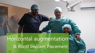 Horizontal augmentation and Roott implant placement [upl. by Melany]