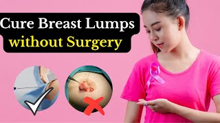 Cure Breast Lump Without Surgery  Breast Fibroadenoma  Non Surgical Treatment [upl. by Roselia]