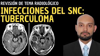 Radiología en 5 minutos Infecciones del sistema nervioso central Tuberculoma [upl. by Naleag100]