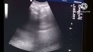 Retroperitoneal cyst on Ultrasound [upl. by Waugh]