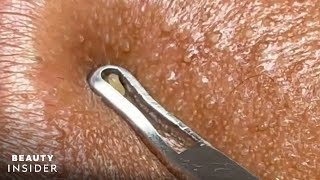 How Lip Blackheads Are Extracted  Beauty Insider [upl. by Wira726]