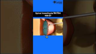 Spinal Anesthesia  Epidural Anesthesia  How Spinal Anesthesia is given shortsviral [upl. by Bach]