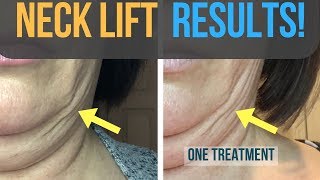 Results From My Fibroblast Plasma Neck Lift [upl. by Maurice]