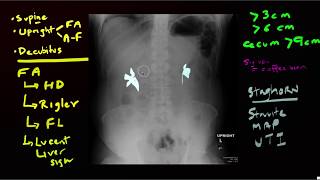 Abdominal Xrays [upl. by Ecirehs101]