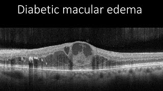 Course in clinical applications of OCT for macular diseases  Diabetic macular edema [upl. by Quiteria]