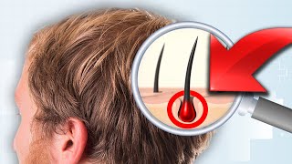 DHT Dihydrotestosterone What It Is Side Effects DHT How It Causes Hair Loss and How to Slow It [upl. by Cung]