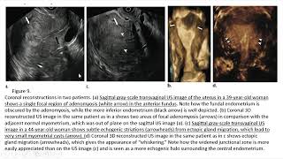 chest Xray signs adenomyosis liver lesions [upl. by Oznofla]