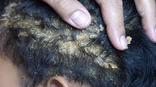 Dandruff scratching removal on head using black combing256 [upl. by Nelleus781]