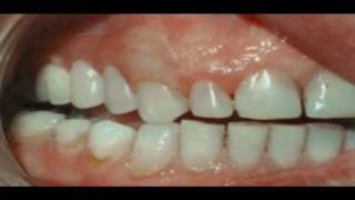 Why Have a Valplast Flexible Denture [upl. by Allcot]