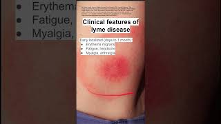 Clinical features of lyme disease [upl. by Artied412]