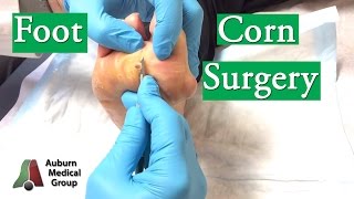 Foot Corn Surgery Treatment [upl. by Bridges413]