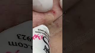 Blackhead Removal Acne Removal Treatment 010 [upl. by Adara]