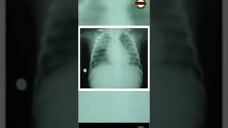 What Is Pulmonary Edema [upl. by Velma]