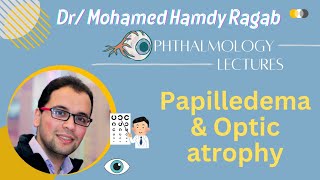 Neuro 3 Papilledema amp Optic atrophy [upl. by Nashom]