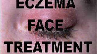 How To Treat Exzema Face  Exzema Face Remedies [upl. by Nirre]