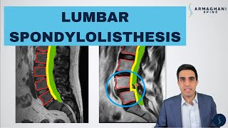 Lumbar Spondylolisthesis  Anatomy Symptoms Causes Treatments and more [upl. by Imit]