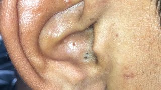 Blackheads in Ear 2024 Today [upl. by Purdy]