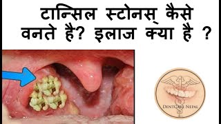 Tonsil Stones  Tonsilloliths Causes and Treatment  IN HINDI [upl. by Yerffoej]