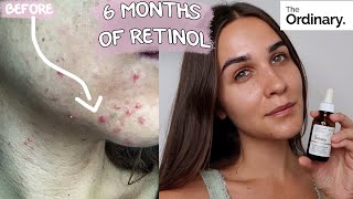 RETINOL CLEARED MY ACNE  BEFORE amp AFTER  6 months update  THE ORDINARY [upl. by Comethuauc]