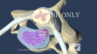 Cervical Disc Herniation [upl. by Gerti]