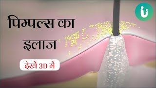 पिम्पल्स क्यों और कैसे होता है 3D में देखें  जानें मुंहासे के लिए क्रीम और इलाज [upl. by Allemrac42]