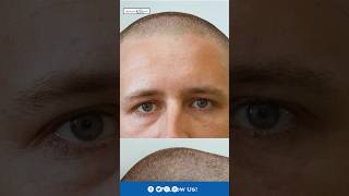 2024 Best hair loss treatment  Should I Worry about my Hair loss  Hair Thinning Causes amp Solution [upl. by Luciano]