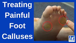 How to Treat Painful Foot Calluses [upl. by Enilraep]