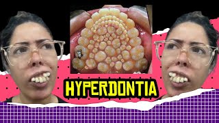 Weird Health News Hyperdontia [upl. by Iline]