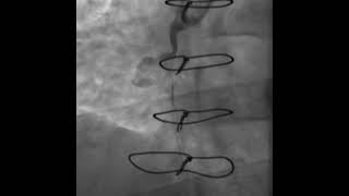 Angiogram showing pseudoaneurysm in saphenous vein graft to right coronary artery [upl. by Sokil]