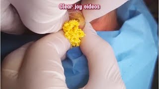 Big Cystic Acne Blackheads Extraction Blackheads amp Milia Whiteheads Removal Pimple Popping [upl. by Cohbath96]