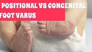 Differentiating positional foot varus and Congenital equinovarus of foot CTEV [upl. by Yekcor]