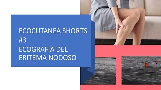 ECOCUTANEA SHORTS 3  ECOGRAFIA DEL ERITEMA NODOSO [upl. by Riaj]