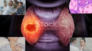 Tumor Markers  Calcitonin  Medullary Thyroid Cancer MTC  The quotbutterflyquot organ  08 [upl. by Ahsimal]