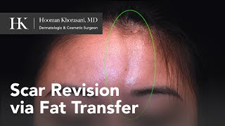 Treatment of Morphea en coup de sabre using Fat Transfer for forehead scar  Dr Hooman Khorasani [upl. by Fiedling517]