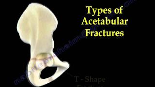 Acetabular Fractures  Everything You Need To Know  Dr Nabil Ebraheim [upl. by Tjon]