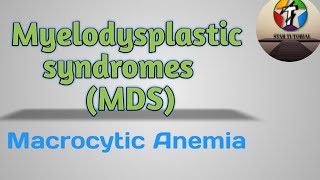 Myelodysplastic syndromes MDS in Hindi ll Macrocytic Anemia ll [upl. by Netsrek]