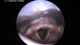 Videostroboscopy of a singer How does your voice work [upl. by Sinnaoi]