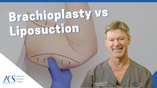 Brachioplasty Arm Lift Surgery Vs Liposuction Explained By Plastic Surgeon Dr Tom McFadden [upl. by Arykahs]