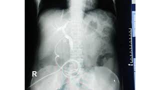 T Tube Cholangiography [upl. by Tenej60]