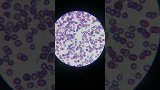 Microcytic hypochromic anemia  anemia  special smear  iron diffiency Anemia anemia under 🔬 [upl. by Ahsaei]