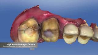 CEREC Restorations with SpeedCEM Plus [upl. by Reese794]