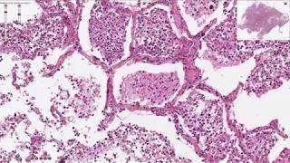 Histopathology  Bronchopneumonia [upl. by Ileyan]