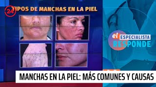 Manchas en la piel Tipos más comunes y sus causas  24 Horas TVN Chile [upl. by Yatnoj616]