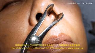 鼻翼囊腫 鼻齒槽囊腫 nasoalveolar cyst nasolabial cyst [upl. by Gavan]